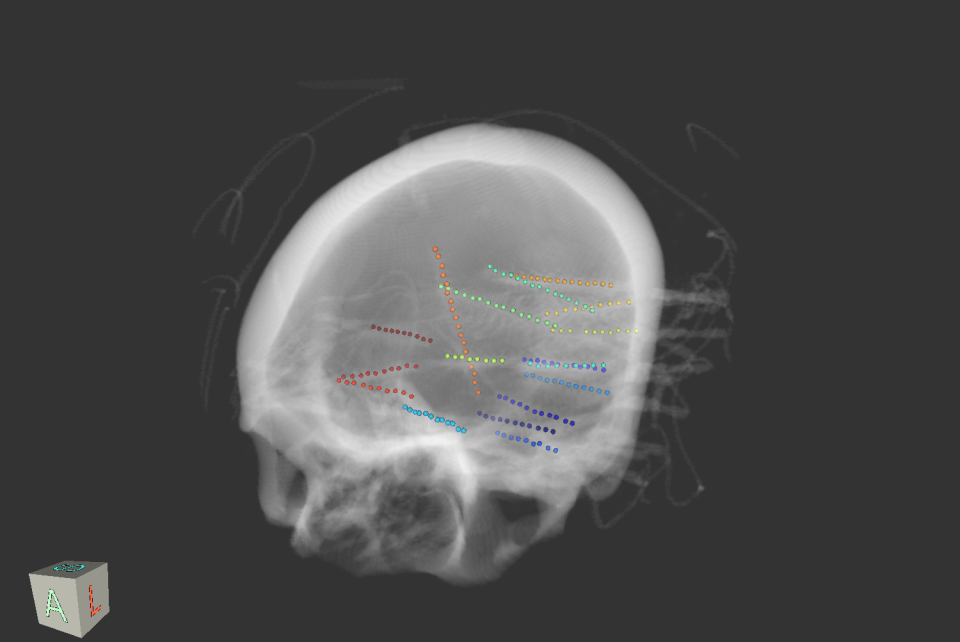 BrainX3 » electrodes_CT_sub04